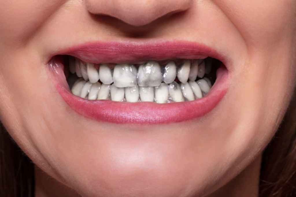 Activated Charcoal for Teeth Whitening