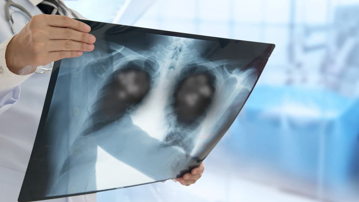 E-cigs can damage lung