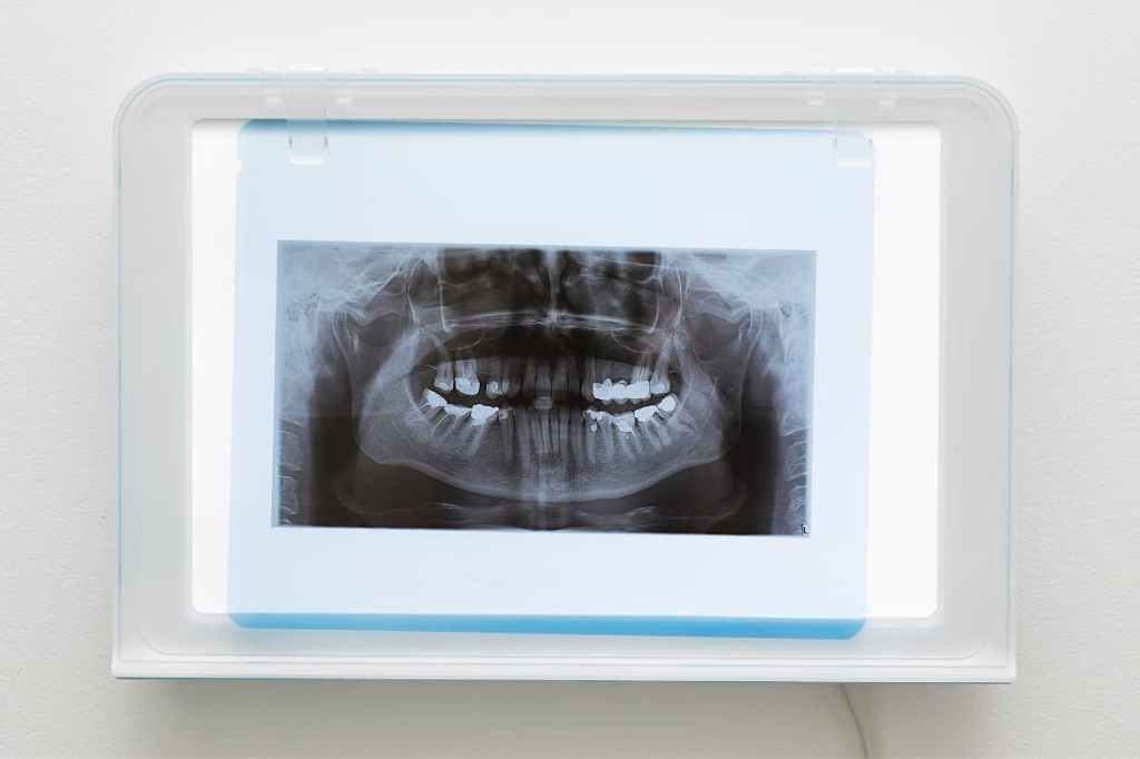 X-Rays Dental Implants