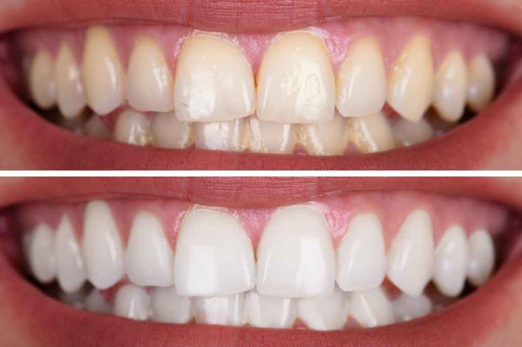 Purple Toothpaste and Composite Bonding or Restorations